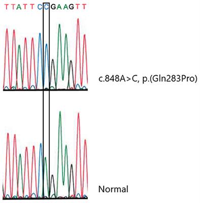 Case report: A novel variant in SLC25A46 causing sensorimotor polyneuropathy and optic atrophy